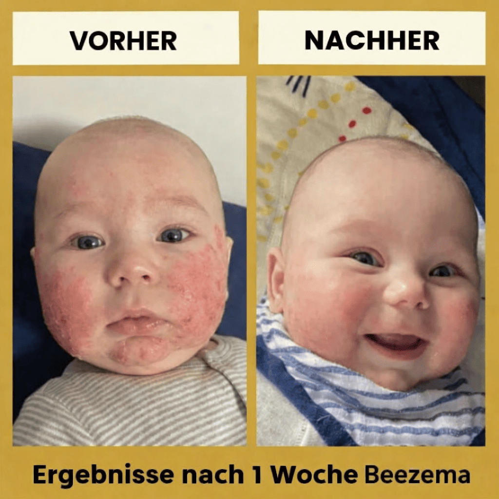 Beezema Honey Baby Ekzem-Beruhigungscreme